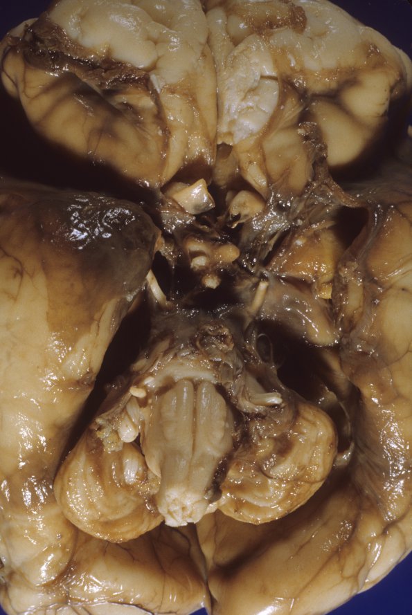 1A3 Hydrocephalus following IVH (Case 1) 1