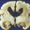 1A4 Hydrocephalus following IVH (Case 1)