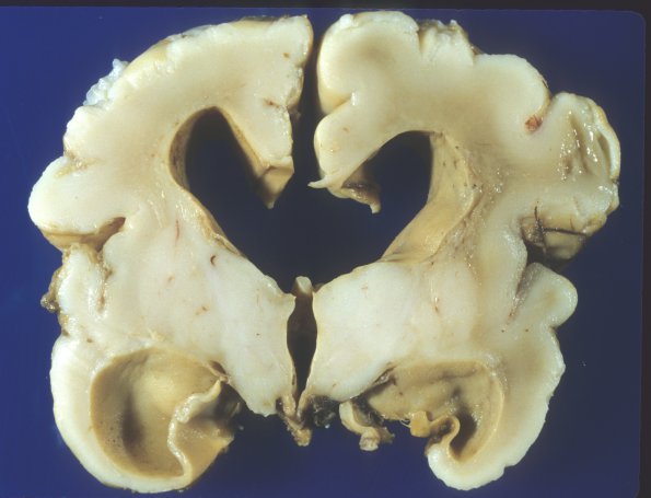 1A4 Hydrocephalus following IVH (Case 1)