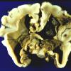 1A5 Hydrocephalus following IVH (Case 1) gross 1