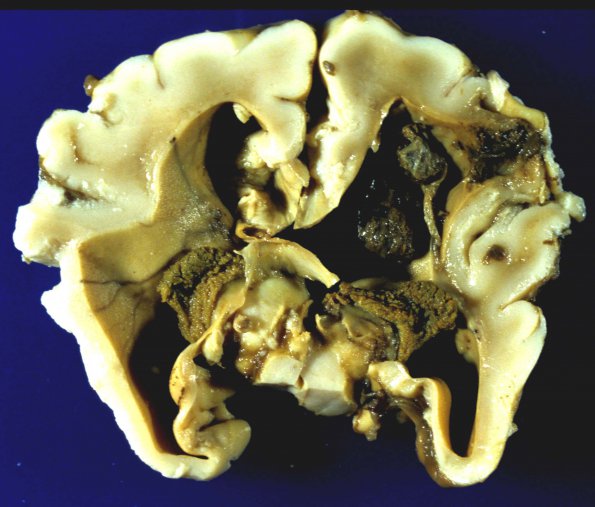 1A5 Hydrocephalus following IVH (Case 1) gross 1