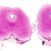 1B1 Hydrocephalus following IVH (Case 1) D H&E WM copy