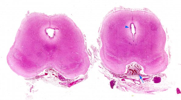 1B1 Hydrocephalus following IVH (Case 1) D H&E WM copy