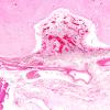 1B2 Hydrocephalus following IVH (Case 1) D H&E 2X