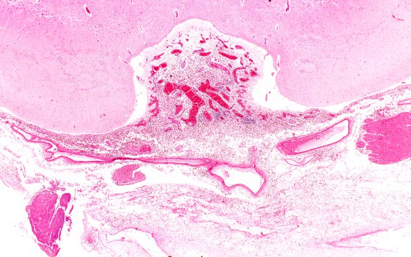 1B2 Hydrocephalus following IVH (Case 1) D H&E 2X