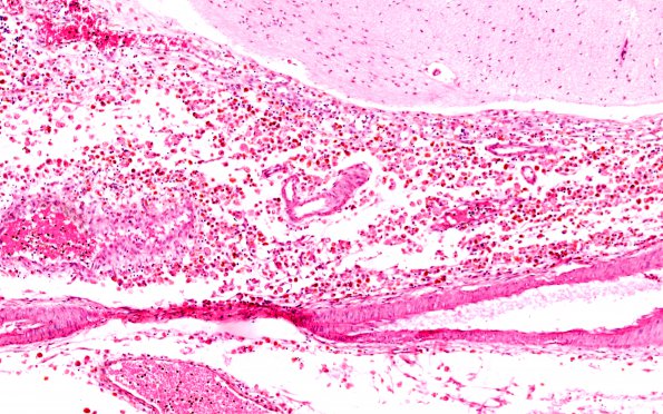 1B3 Hydrocephalus following IVH (Case 1) D H&E 20X