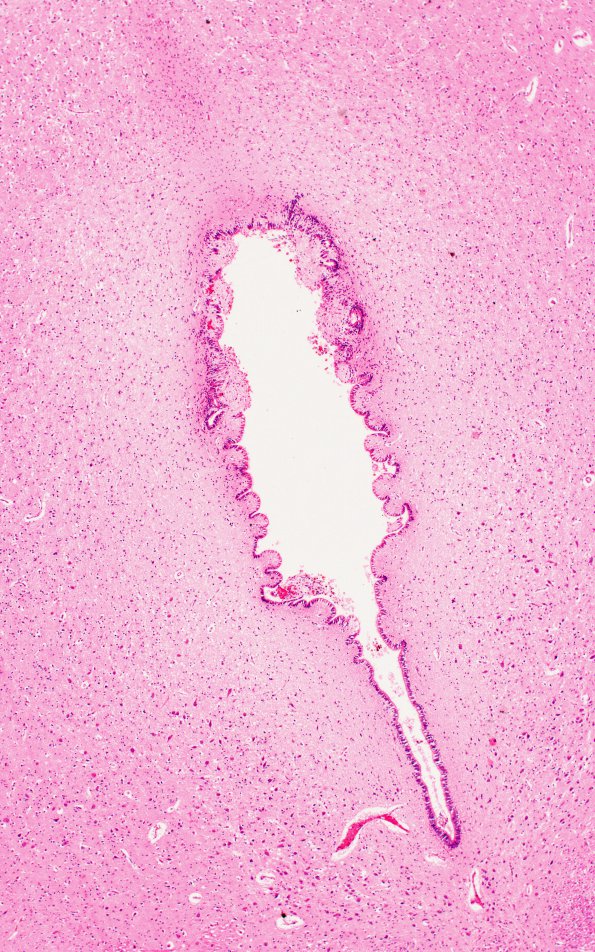 1B4 Hydrocephalus following IVH (Case 1) D H&E 4X