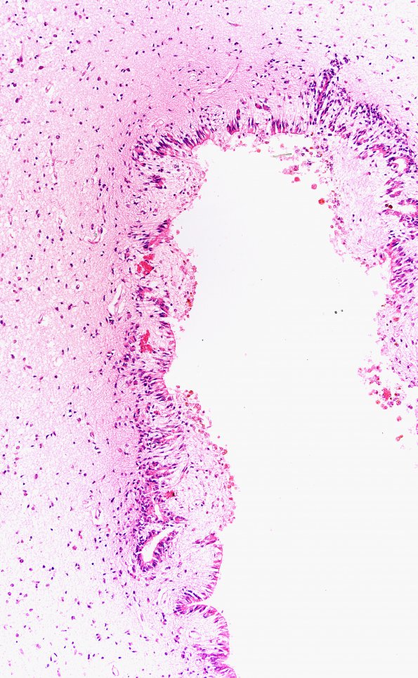 1B5 Hydrocephalus following IVH (Case 1) D