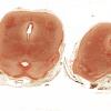 1B6 Hydrocephalus following IVH (Case 1) D Trichrome WM