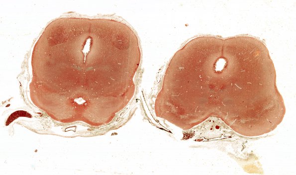 1B6 Hydrocephalus following IVH (Case 1) D Trichrome WM