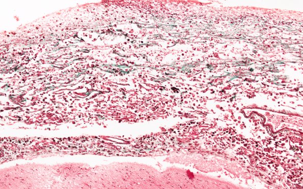 1B7 Hydrocephalus following IVH (Case 1) D Trichrome 1