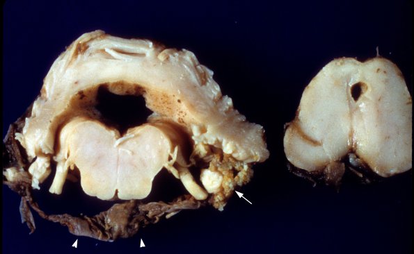 1C1 Hydrocephalus & IVH (Case 1) copy