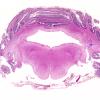 1C2 Hydrocephalus following IVH (Case 1) F H&E WM copy