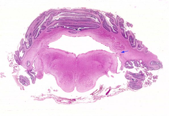 1C2 Hydrocephalus following IVH (Case 1) F H&E WM copy