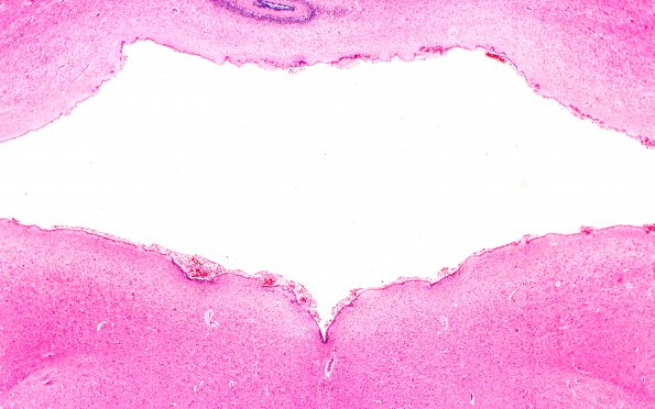 1C3 Hydrocephalus following IVH (Case 1) D H&E 2X 2