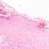 1C4 Hydrocephalus following IVH (Case 1) D H&E 1