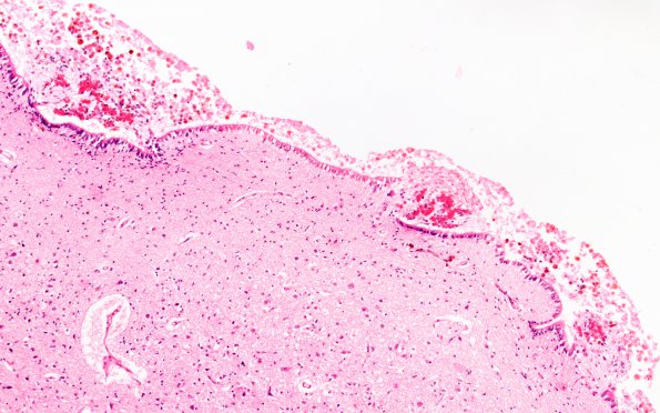 1C4 Hydrocephalus following IVH (Case 1) D H&E 1