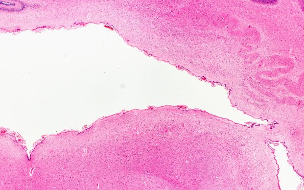 1C5 Hydrocephalus following IVH (Case 1) D H&E 2X 1