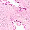 1C6 Hydrocephalus following IVH (Case 1) F H&E 20X 1