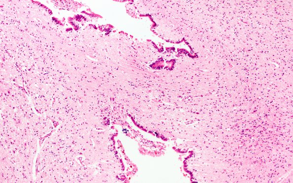 1C6 Hydrocephalus following IVH (Case 1) F H&E 20X 1