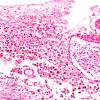 1C7 Hydrocephalus following IVH (Case 1) F H&E Medulla