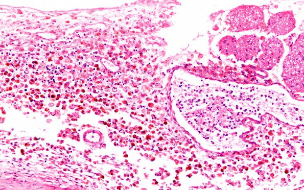 1C7 Hydrocephalus following IVH (Case 1) F H&E Medulla