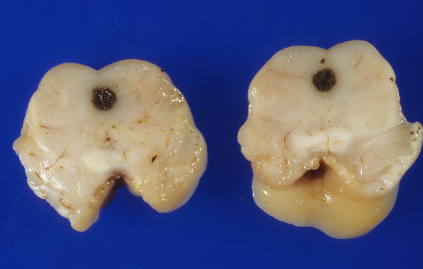 2A4 Hydrocephalus after IVH (Case 2) gross 2