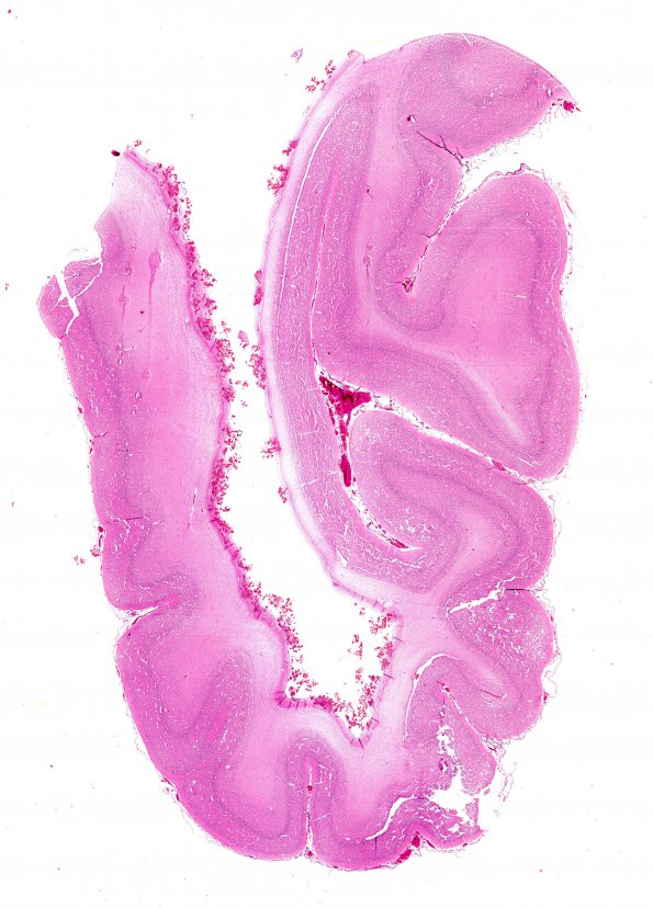 2B1 Hydrocephalus after IVH (Case 2) E WM