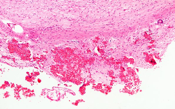 2B2 Hydrocephalus after IVH (Case 2) E 10X