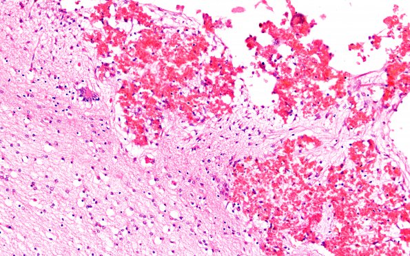 2B3 Hydrocephalus after IVH (Case 2) E 20X