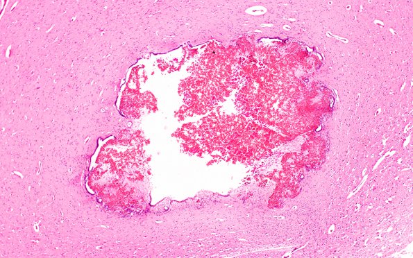 2B4 Hydrocephalus after IVH (Case 2) Midbrain 20X