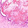 2B5 Hydrocephalus after IVH (Case 2) Midbrain 2X