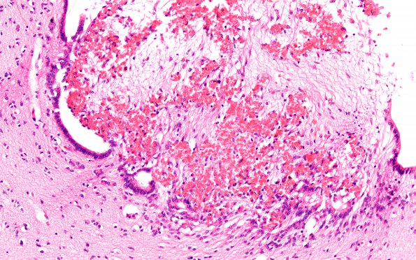 2B5 Hydrocephalus after IVH (Case 2) Midbrain 2X