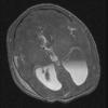 3A1 Hydrocephalus IVH (Case 3) cow angio - Copy