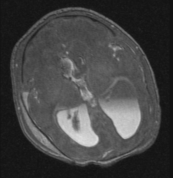 3A1 Hydrocephalus IVH (Case 3) cow angio - Copy