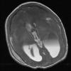 3A2 Hydrocephalus IVH (Case 3) T1 - Copy