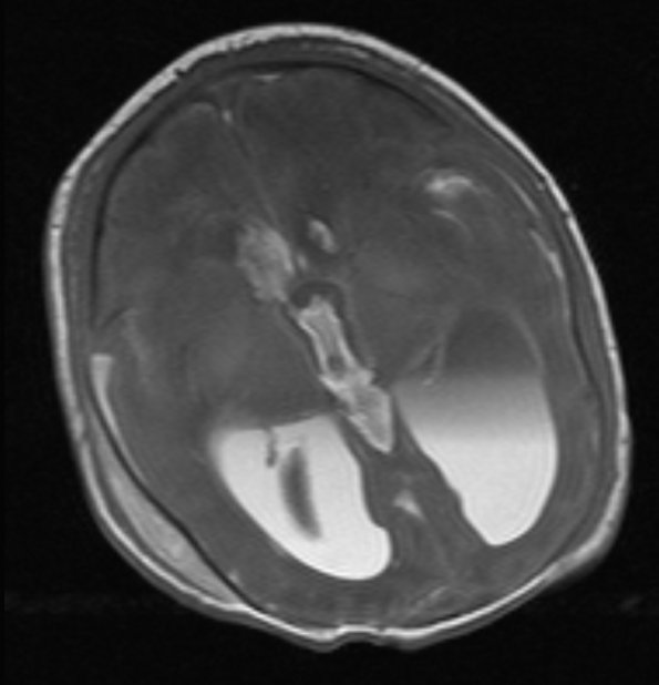 3A2 Hydrocephalus IVH (Case 3) T1 - Copy