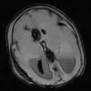 3A3 Hydrocephalus IVH (Case 3) T2 fl2d hemo - Copy