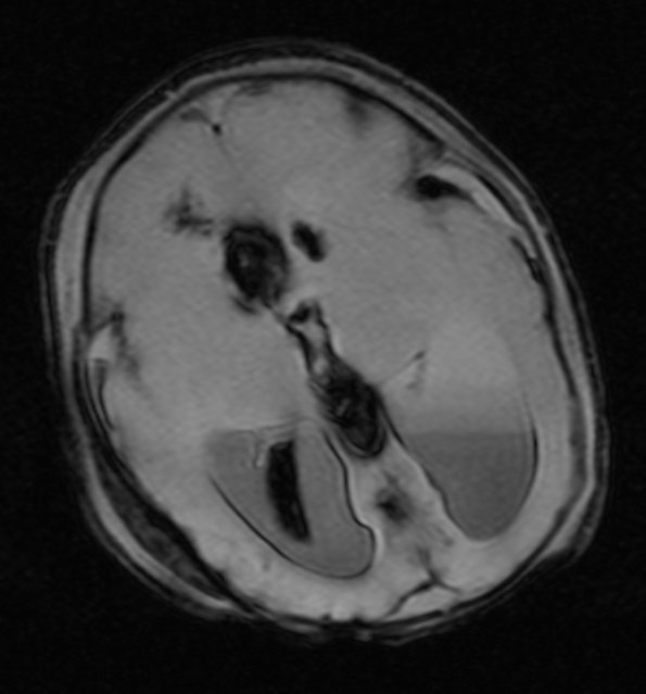 3A3 Hydrocephalus IVH (Case 3) T2 fl2d hemo - Copy