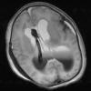 3A4 Hydrocephalus IVH (Case 3) T2 - Copy