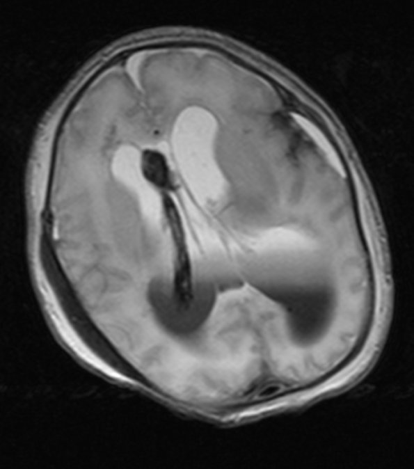 3A4 Hydrocephalus IVH (Case 3) T2 - Copy