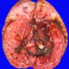 3B1 Hydrocephalus after IVH (Case 3) 12