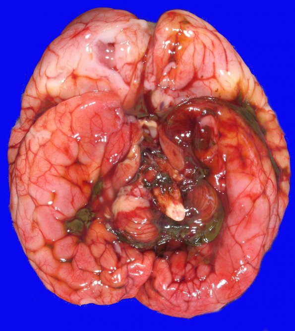 3B1 Hydrocephalus after IVH (Case 3) 12