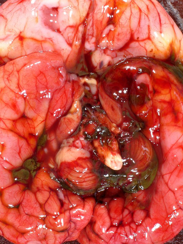 3B2 Hydrocephalus after IVH (Case 3) 13