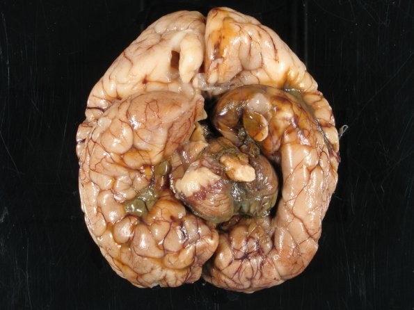 3B3 Hydrocephalus after IVH (Case 3) 11