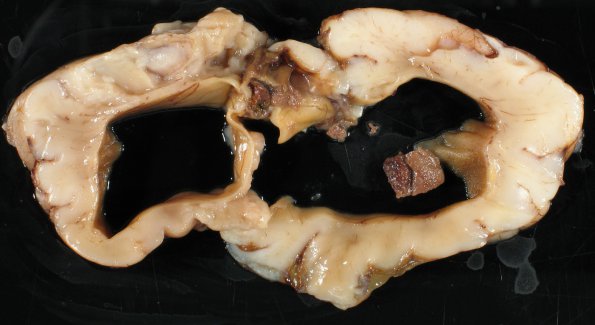 3B4 Hydrocephalus after IVH (Case 3) gross 7