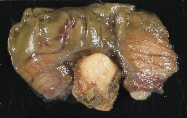 3B5 Hydrocephalus after IVH (Case 3) gross 2