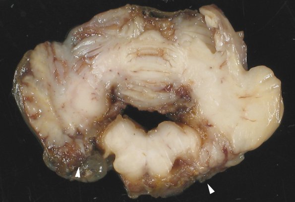 3B6 Hydrocephalus after IVH (Case 3) gross 4 copy