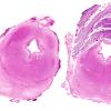 3C1 Hydrocephalus after IVH (Case 3) H&E 2A