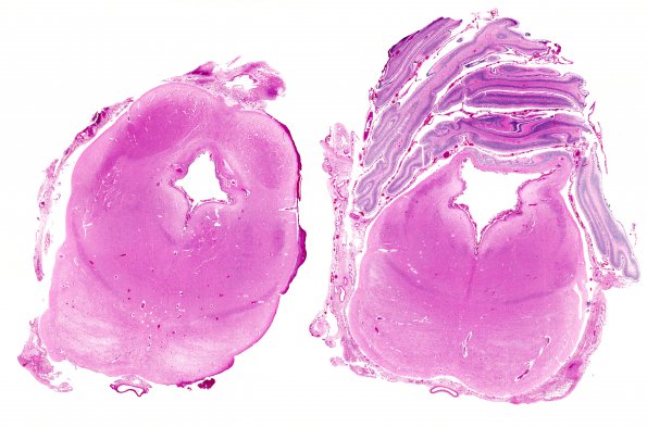 3C1 Hydrocephalus after IVH (Case 3) H&E 2A